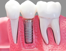 dental implant illustration