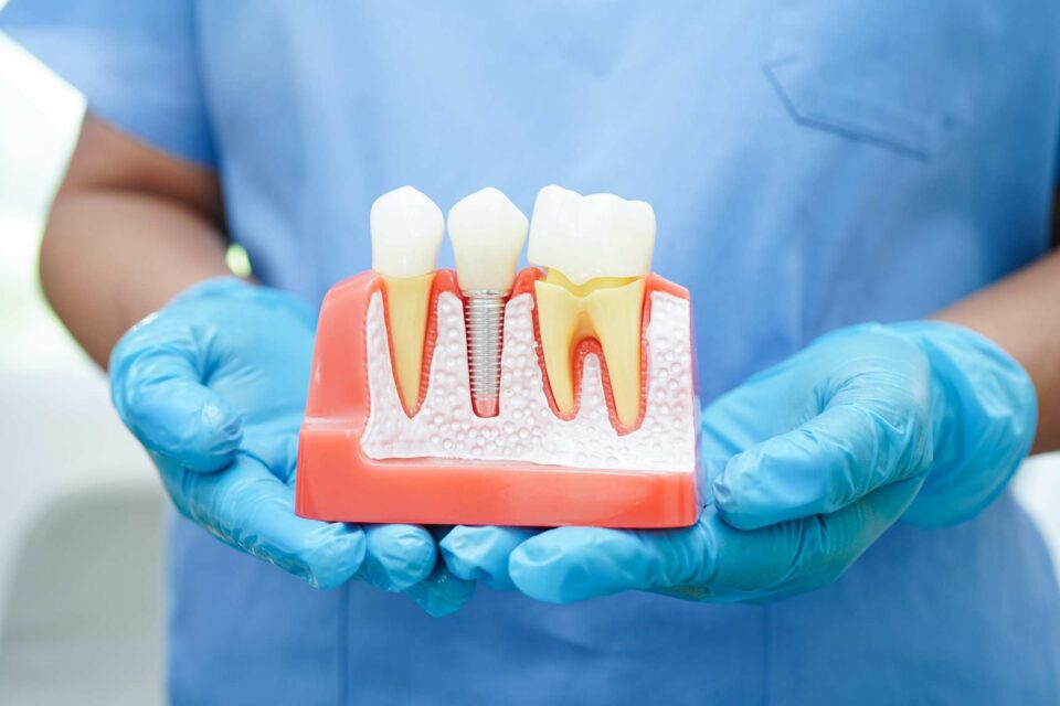 Dental implant and crown model at Creve Coeur Dental in Creve Coeur, MO, for patient education.
