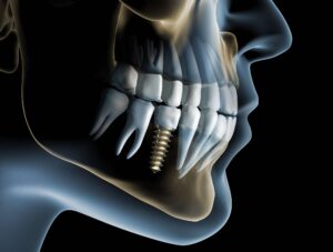 Dental implant model at Creve Coeur Dental in Creve Coeur, MO, showing bone integration & stability.