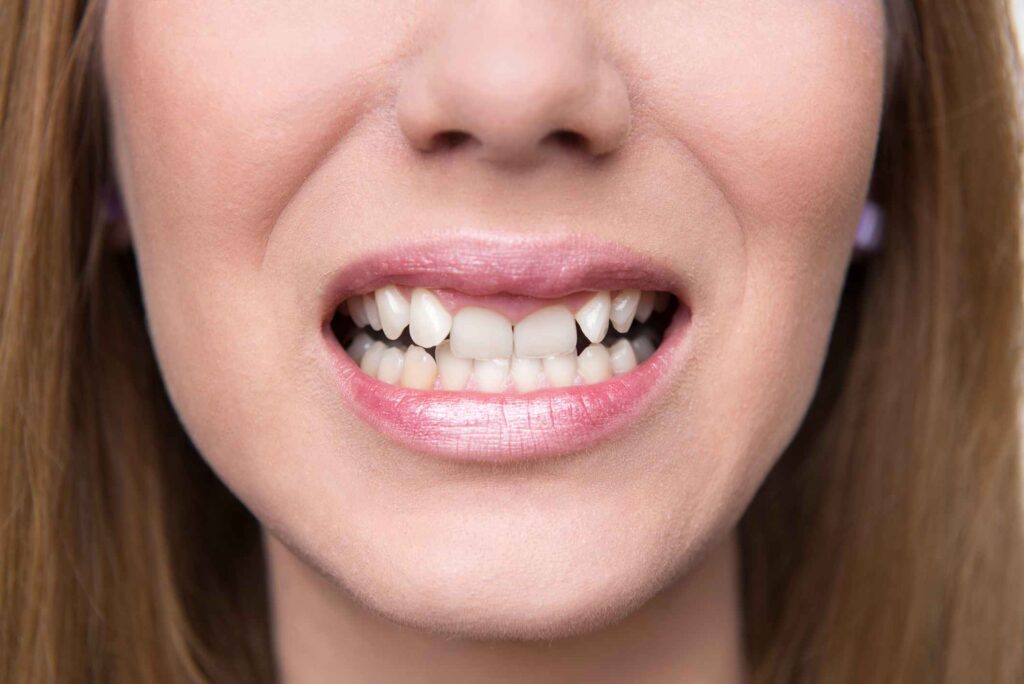 Close-up of crowded teeth needing orthodontic care in Creve Coeur, MO
