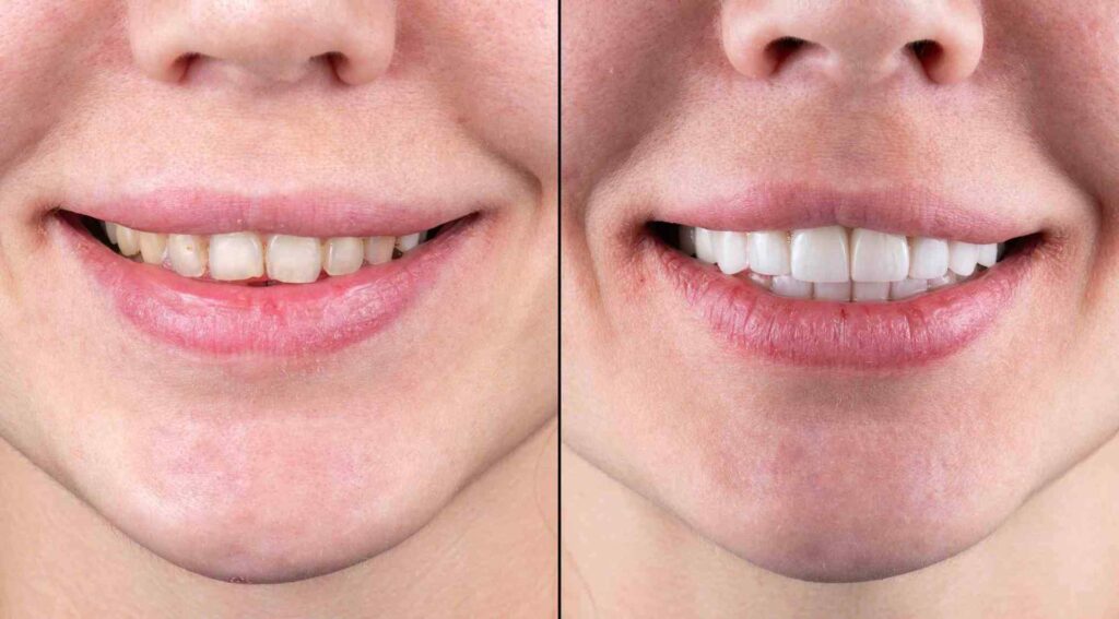 Smile before & after getting veneers, showing improved tooth color and alignment in Creve Couer, MO.