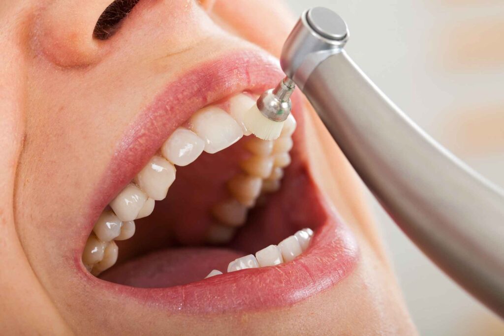A dental professional polishing a patient's teeth during a routine cleaning in Creve Coeur, MO