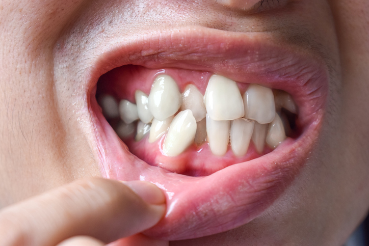 Stacked or overlapping white teeth of Asian man. Also called crowded teeth.